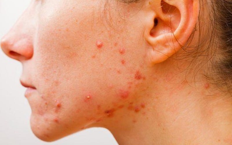 Comment enlever un microkyste du visage