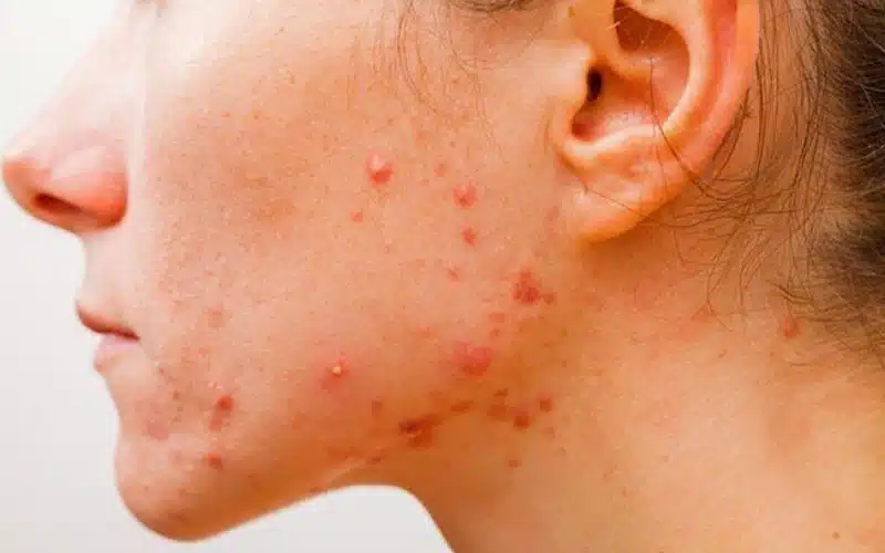 Comment enlever un microkyste du visage